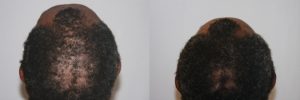mens-hair-restoration-2