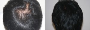 mens hair restoration - New Beginnings Family