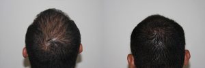 mens-hair-restoration-25