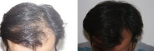 mens-hair-restoration-9