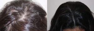 womens-hair-restoration-11