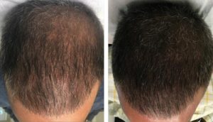 Scalp Micropigmentation at New Beginnings Family
