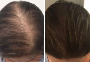 Scalp Micropigmentation at New Beginnings Family for Women
